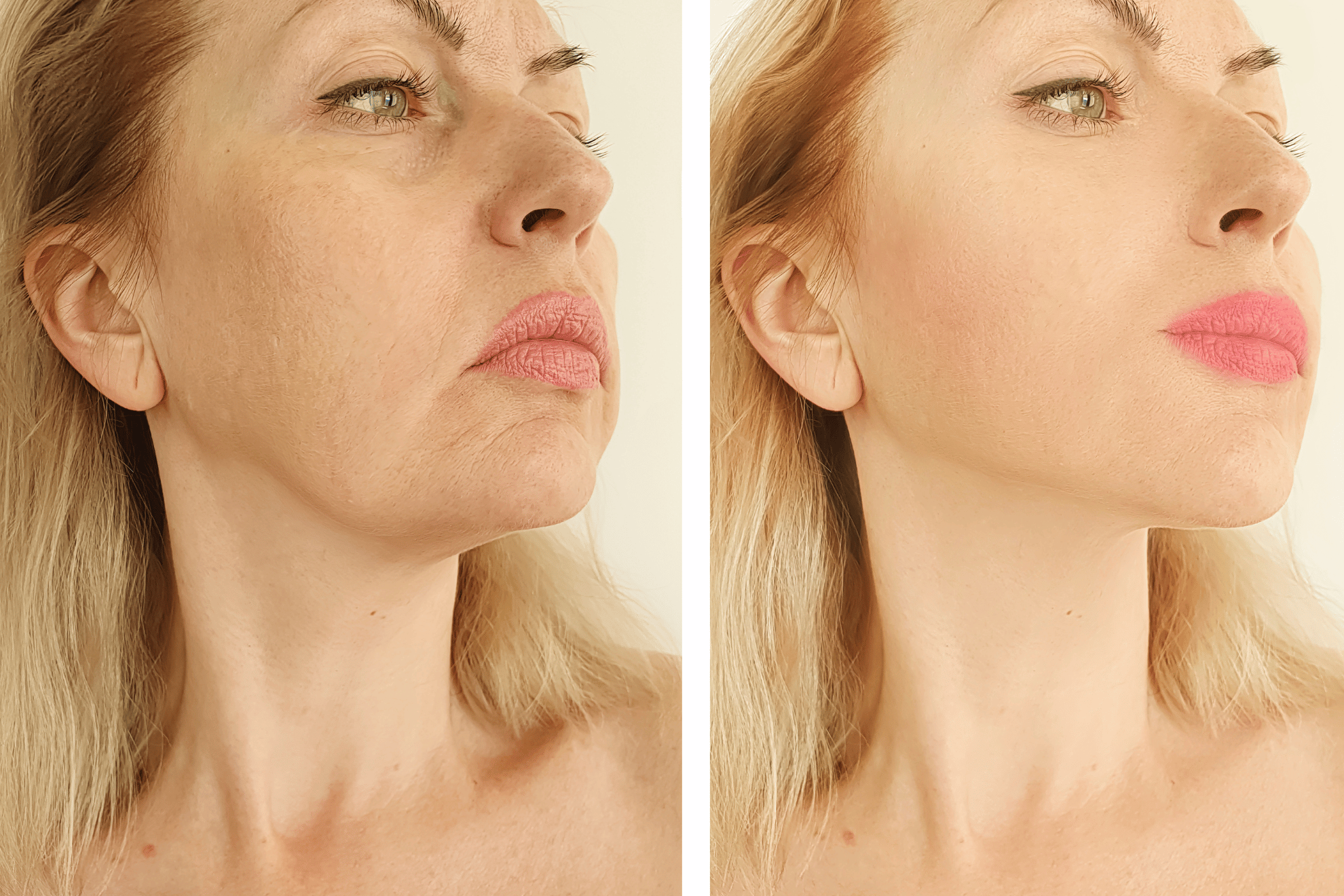 elimina capillari, rughe, macchie del sole, cicatrici da acne