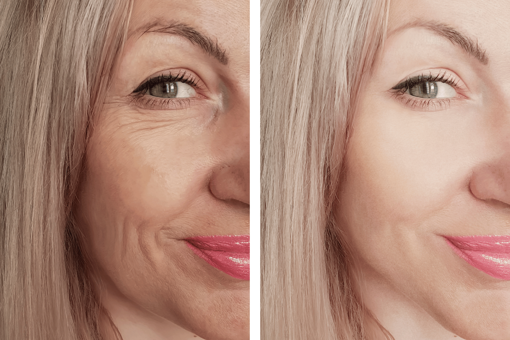 elimina capillari, rughe, macchie del sole, cicatrici da acne