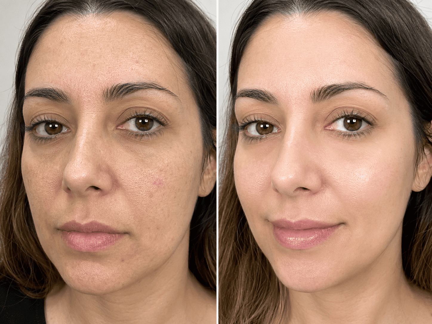 Carbon Peel Laser Prima e Dopo